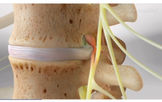 back pain herniated disc