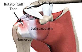 rotator cuff injuries