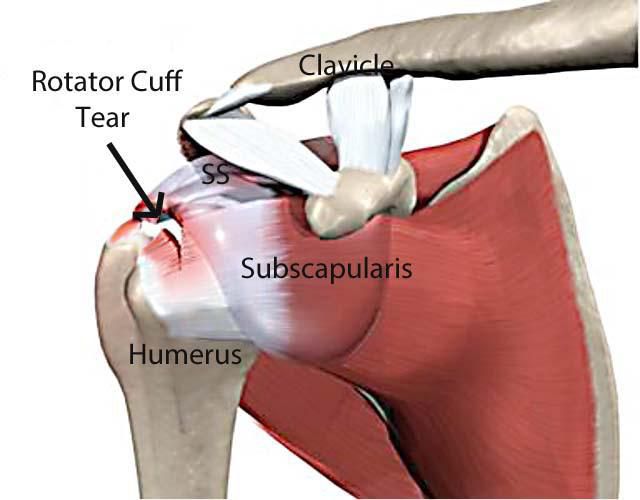 rotator cuff injuries