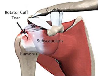 rotator cuff pain Houston at IPainspecialist